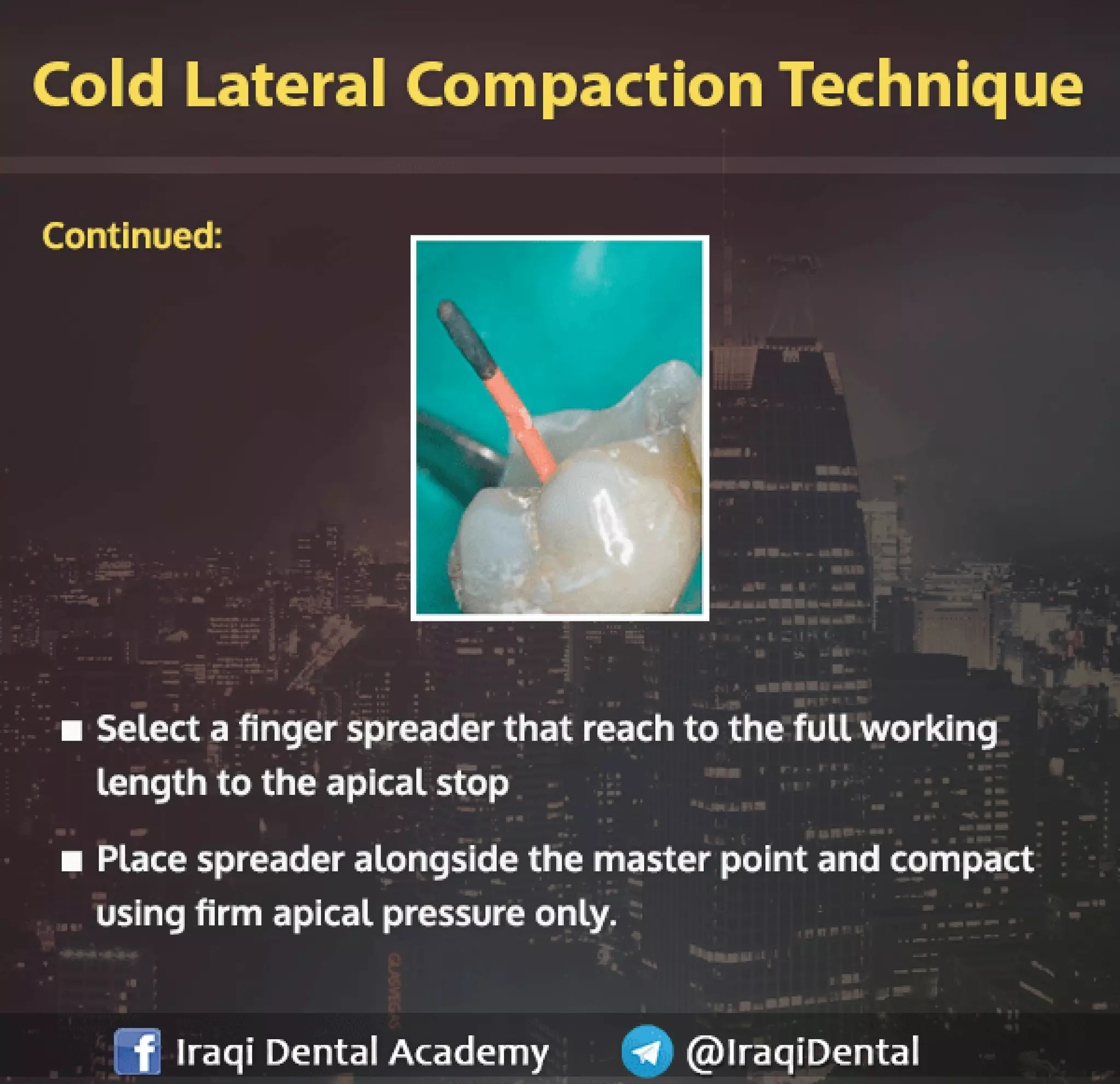 Obturation of Root Canal - Brief Presentation