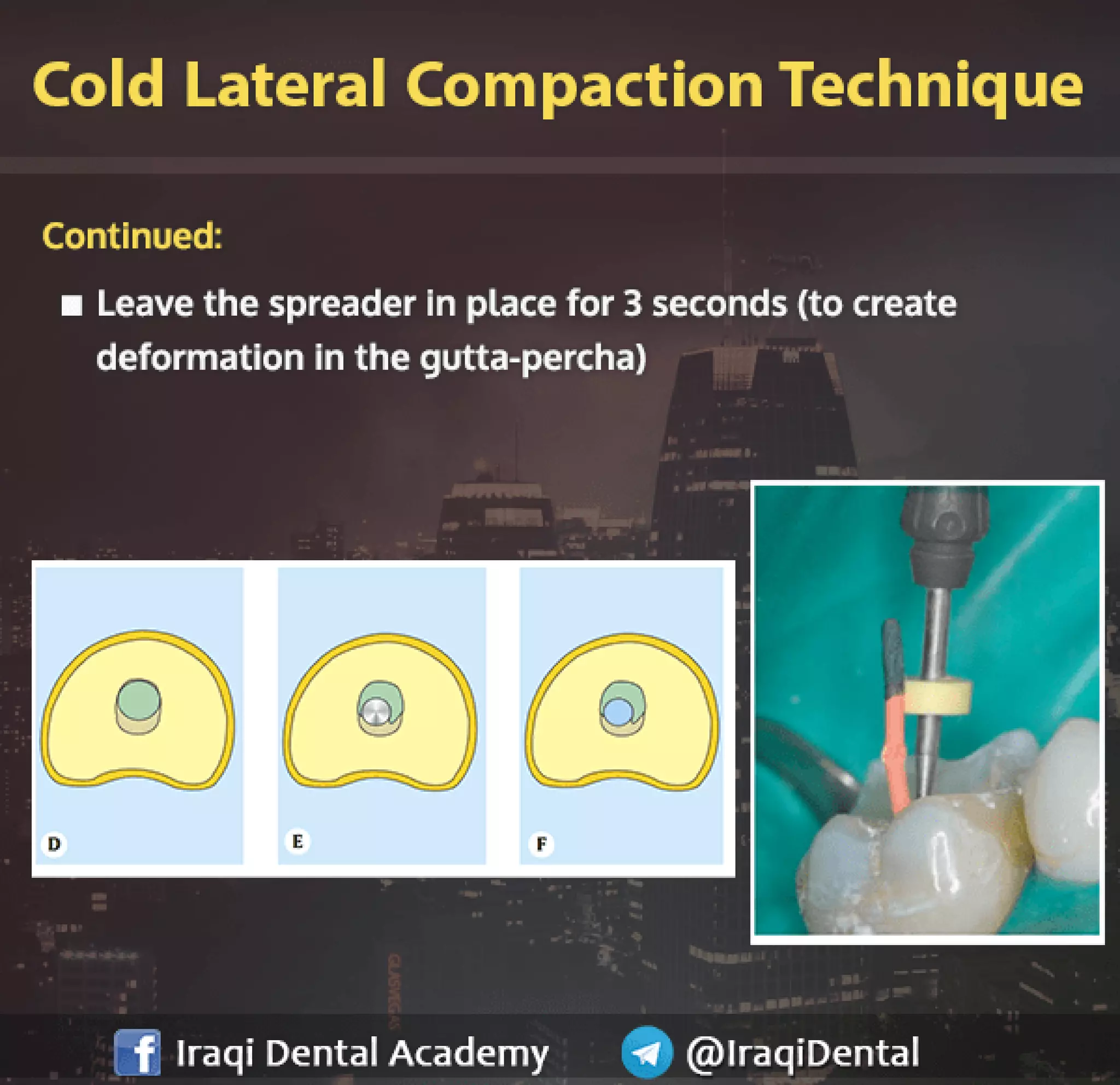Obturation of Root Canal - Brief Presentation