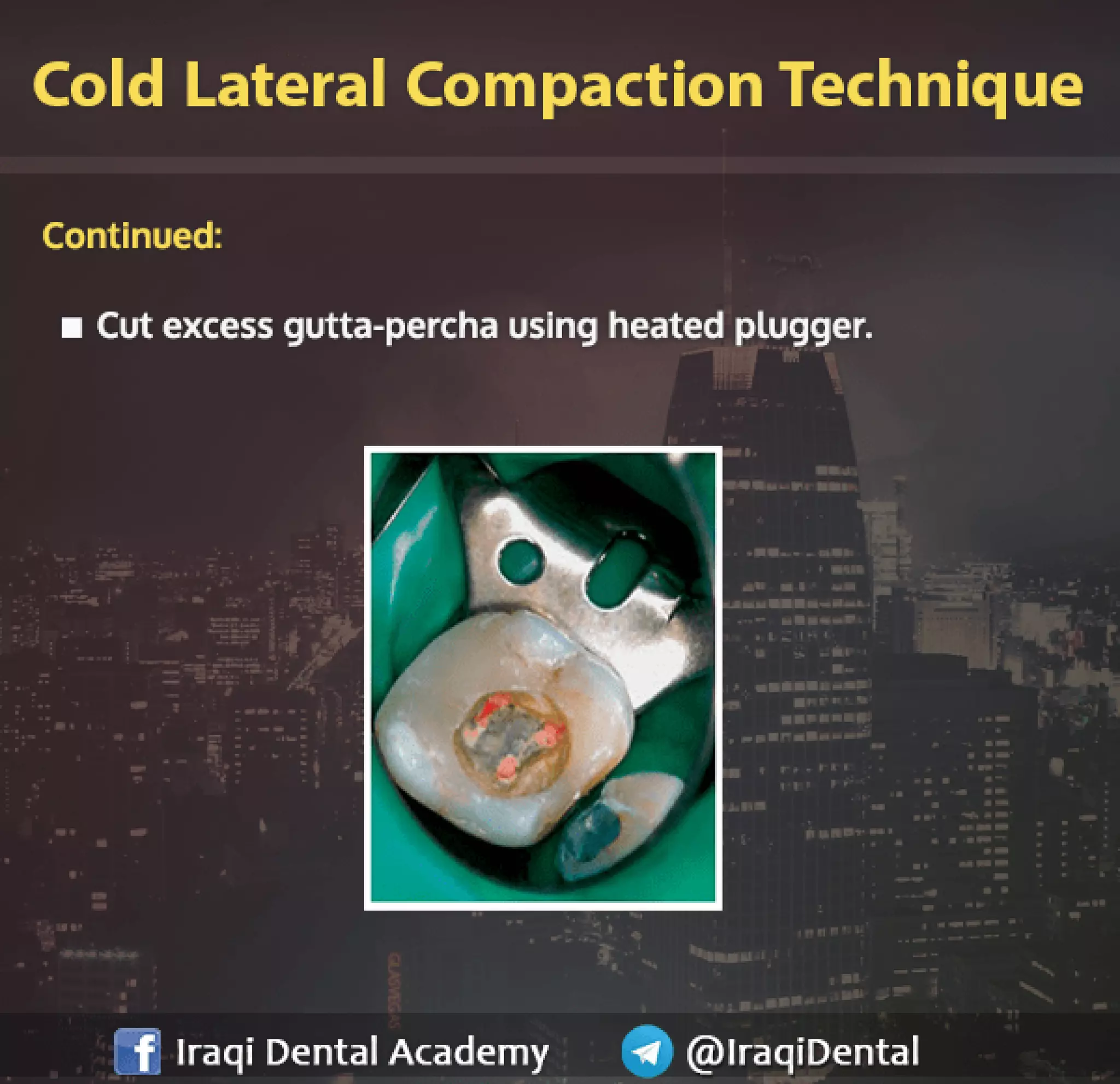 Obturation of Root Canal - Brief Presentation