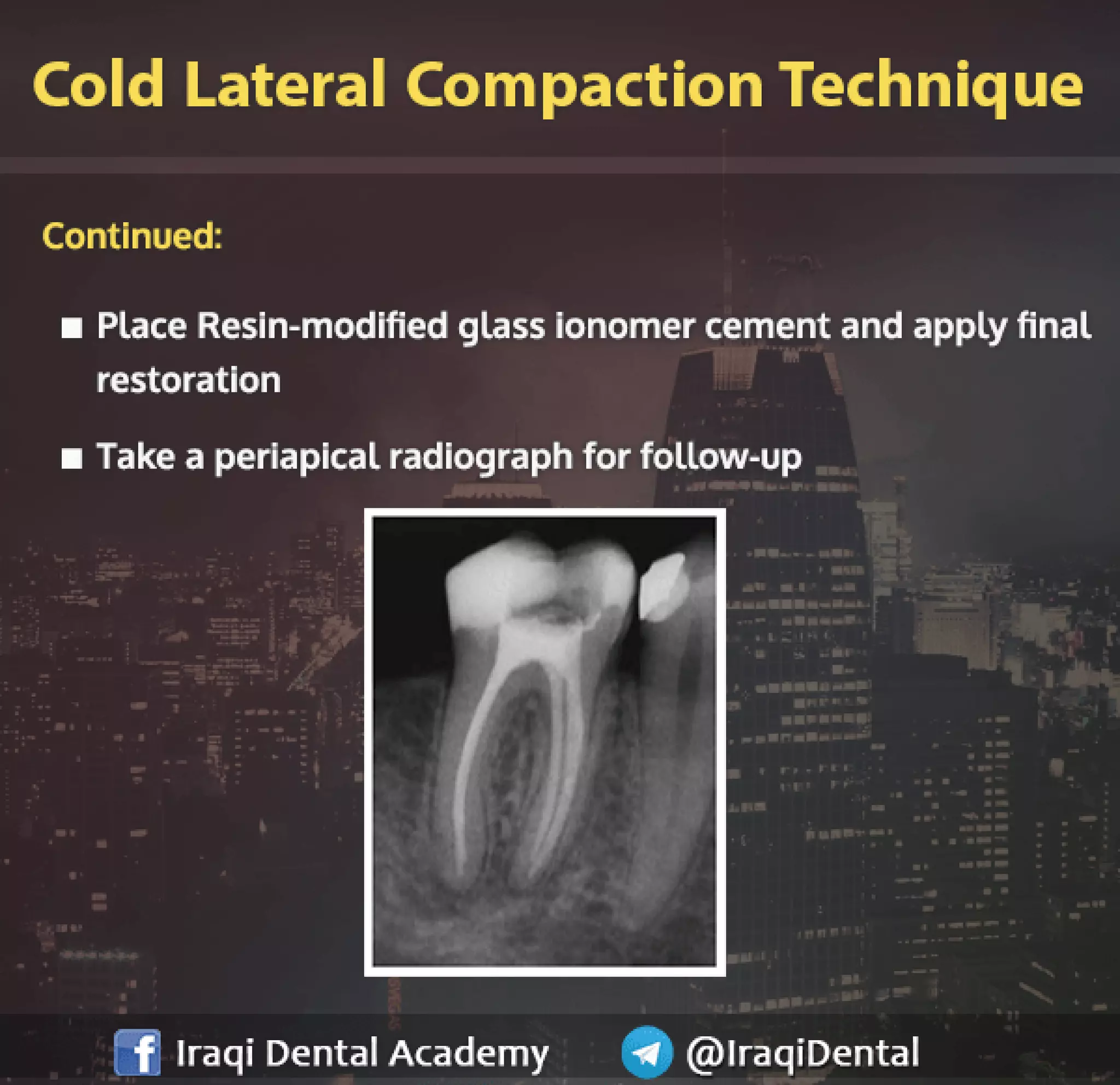 Obturation of Root Canal - Brief Presentation