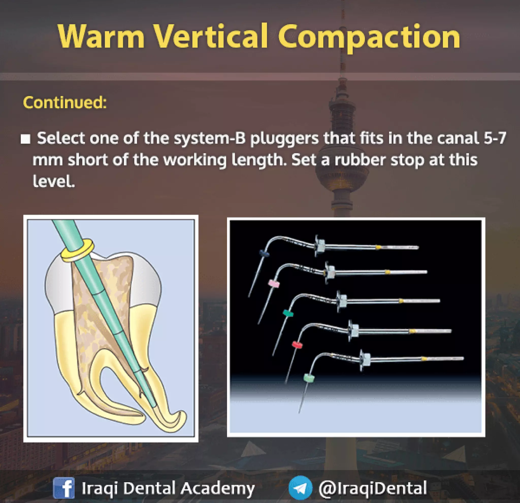 Obturation of Root Canal - Brief Presentation