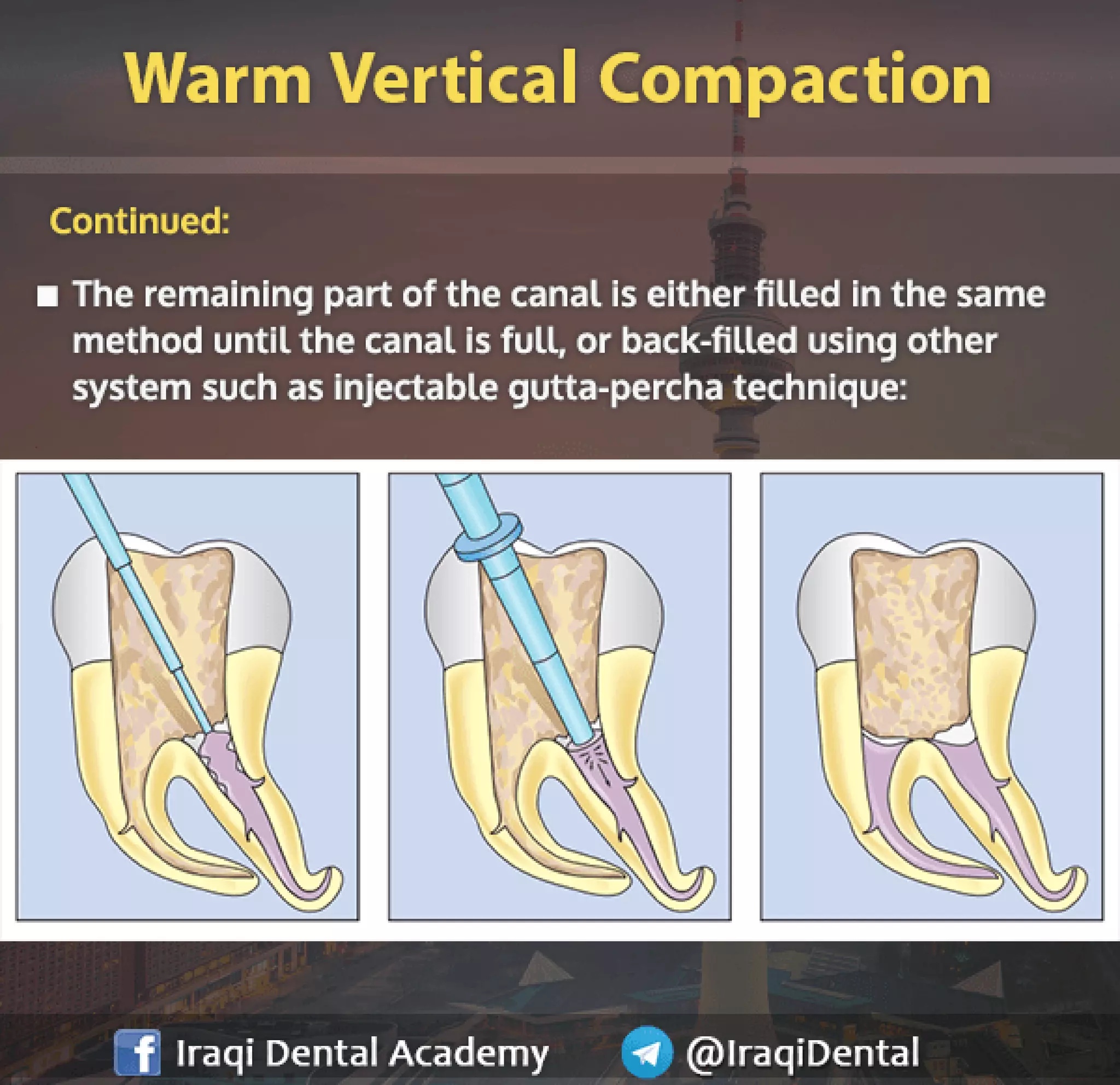 Obturation of Root Canal - Brief Presentation