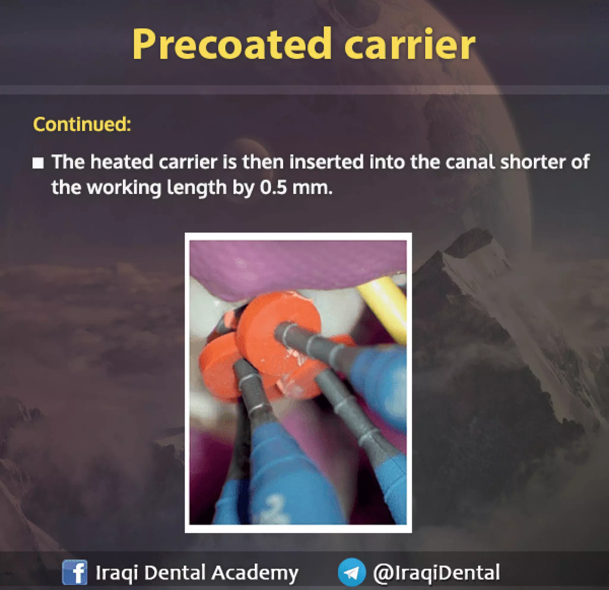 Obturation of Root Canal - Brief Presentation