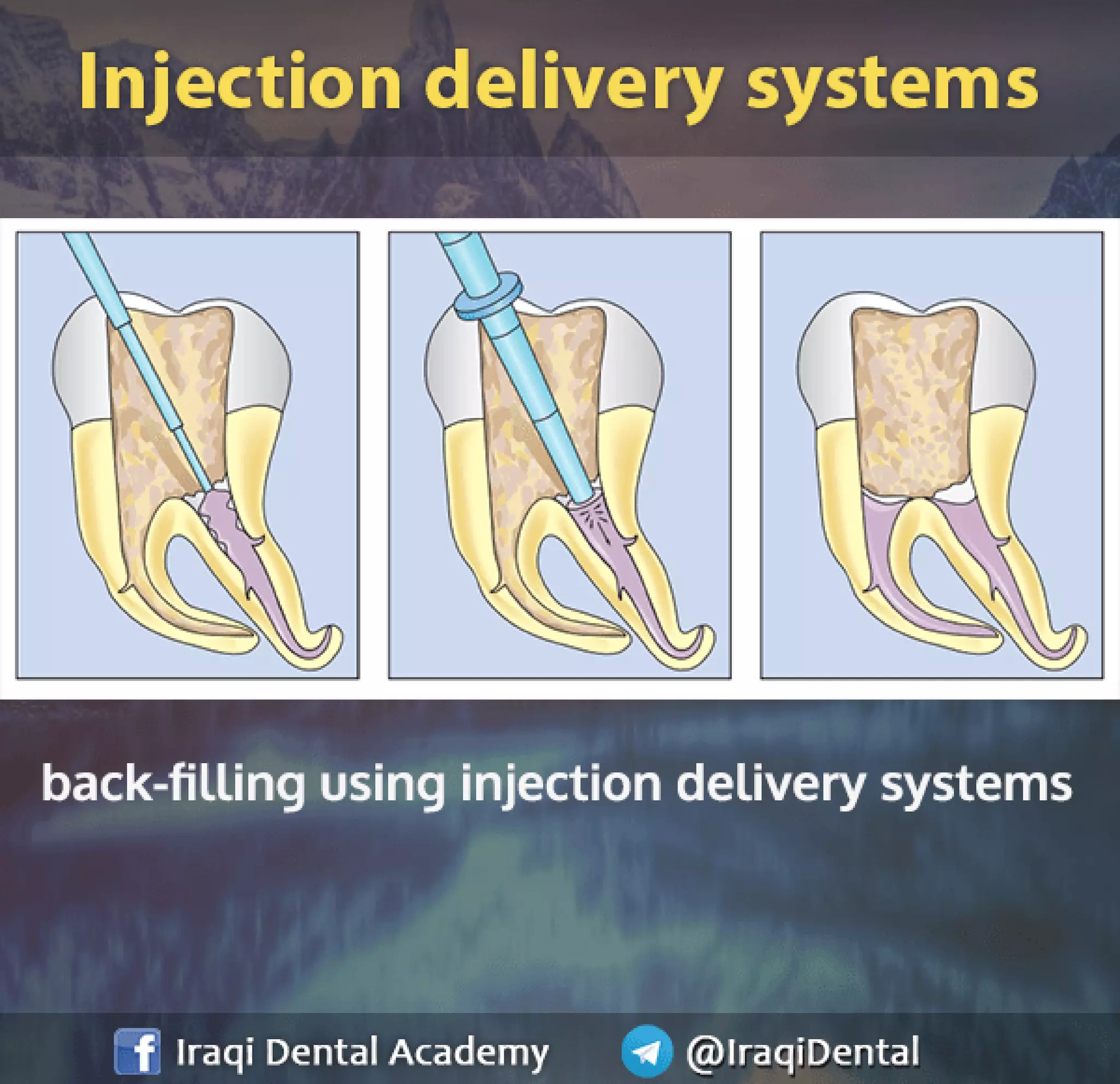 Obturation of Root Canal - Brief Presentation