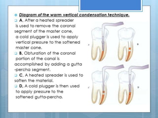 Obturation of root canal system
