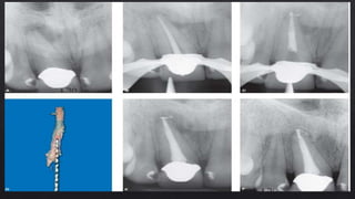 OBTURATION OF ROOT   CANAL SYSTEM.pptx