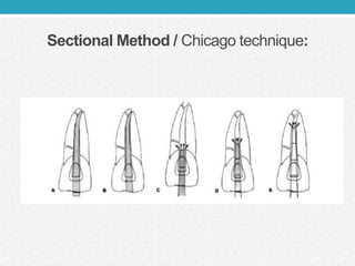 Sectional Method / Chicago technique:
 