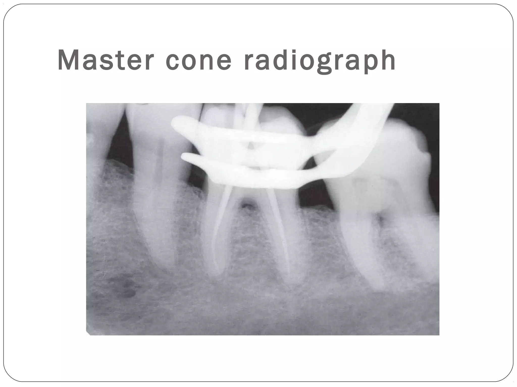 Obturation techniques | PPT