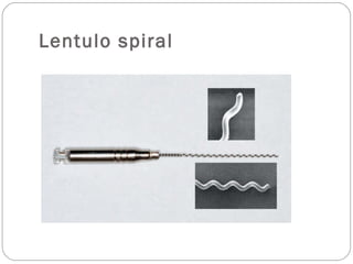 Lentulo spiral
 