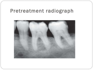 Pretreatment radiograph
 