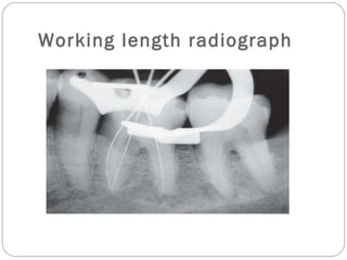 Working length radiograph
 