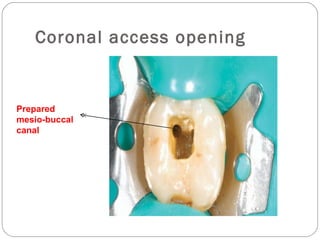 Coronal access opening
Prepared
mesio-buccal
canal
 
