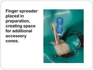 Finger spreader
placed in
preparation,
creating space
for additional
accessory
cones.
 
