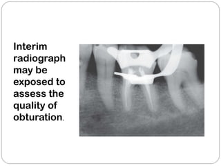 Interim
radiograph
may be
exposed to
assess the
quality of
obturation.
 
