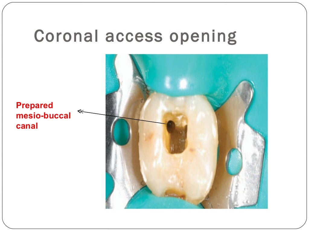 Obturation techniques