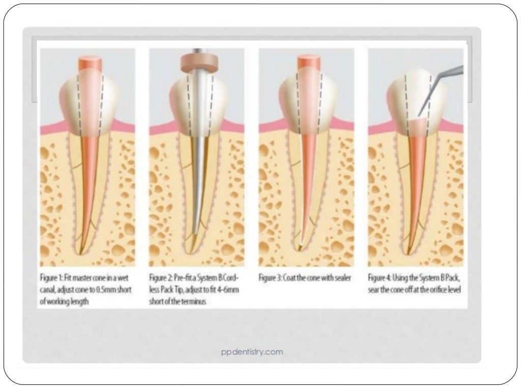 Obturation techniques