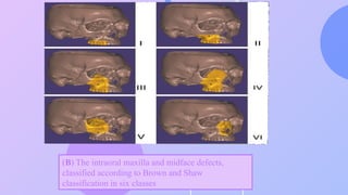 Brown Defect Classification obturator digital lecture talk about types of obturatrors.pptx