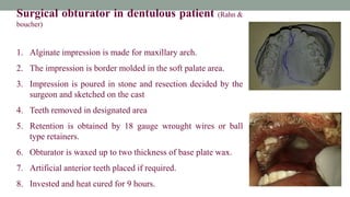 Surgical obturator in dentulous patient (Rahn &
boucher)
1. Alginate impression is made for maxillary arch.
2. The impression is border molded in the soft palate area.
3. Impression is poured in stone and resection decided by the
surgeon and sketched on the cast
4. Teeth removed in designated area
5. Retention is obtained by 18 gauge wrought wires or ball
type retainers.
6. Obturator is waxed up to two thickness of base plate wax.
7. Artificial anterior teeth placed if required.
8. Invested and heat cured for 9 hours.
 