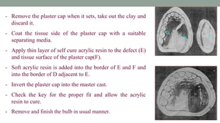 - Remove the plaster cap when it sets, take out the clay and
discard it.
- Coat the tissue side of the plaster cap with a suitable
separating media.
- Apply thin layer of self cure acrylic resin to the defect (E)
and tissue surface of the plaster cap(F).
- Soft acrylic resin is added into the border of E and F and
into the border of D adjacent to E.
- Invert the plaster cap into the master cast.
- Check the key for the proper fit and allow the acrylic
resin to cure.
- Remove and finish the bulb in usual manner.
E F
D
 