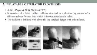 2. INFLATABLE OBTURATOR PROSTHESIS
• A.G.L. Payne & W.G. Welton (1965)
• It consists of a latex rubber balloon attached to a denture by means of a
silicone rubber former, into which is incorporated an air valve.
• The balloon is inflated with air to fill the surgical defect with this inflator.
 