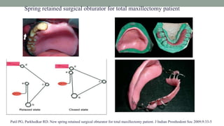 Spring retained surgical obturator for total maxillectomy patient
Patil PG, Parkhedkar RD. New spring retained surgical obturator for total maxillectomy patient. J Indian Prosthodont Soc 2009;9:33-5
 