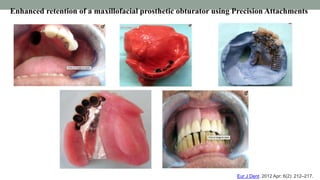 Enhanced retention of a maxillofacial prosthetic obturator using Precision Attachments
Eur J Dent. 2012 Apr; 6(2): 212–217.
 