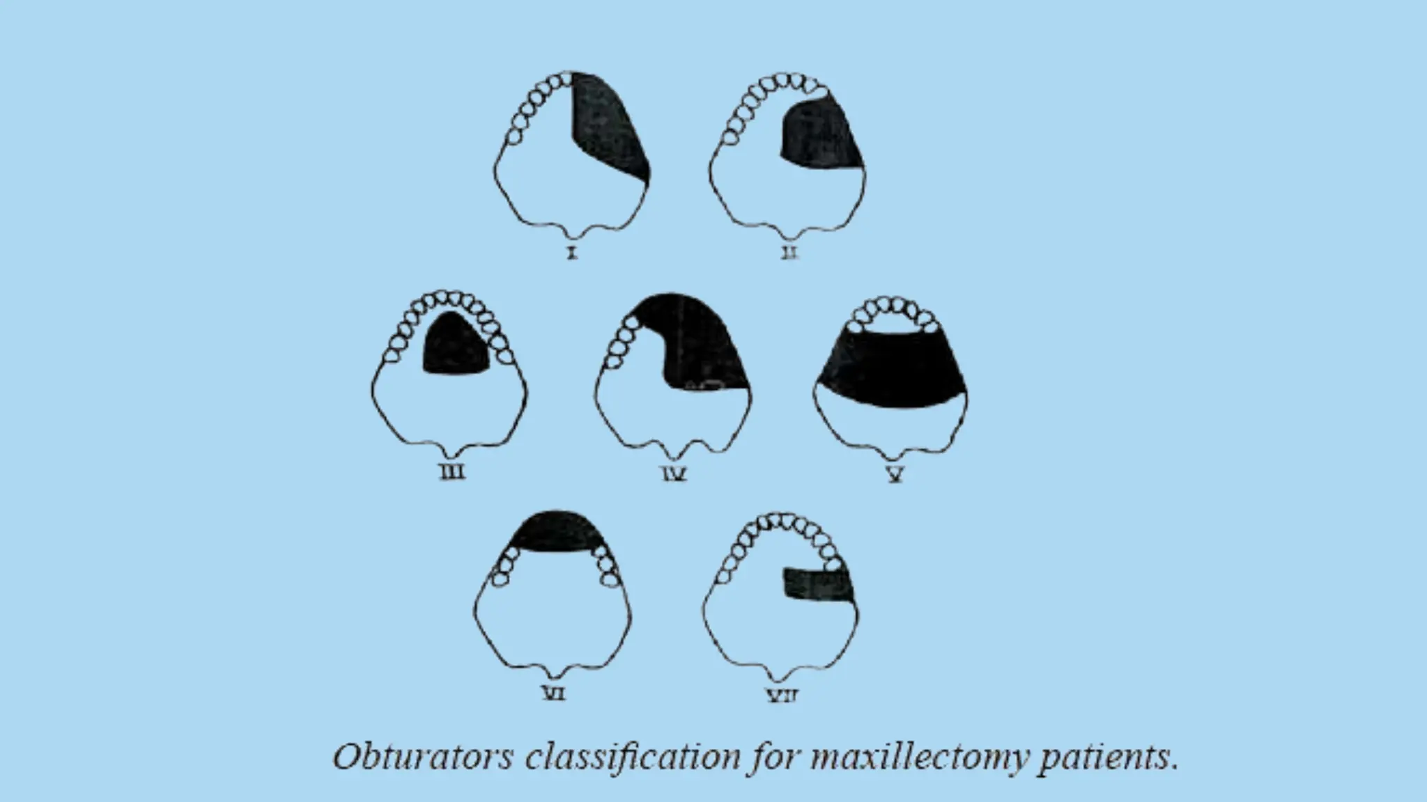 Brief discussion for Obturators used in Maxillofacial Rehabilitation | PPTX