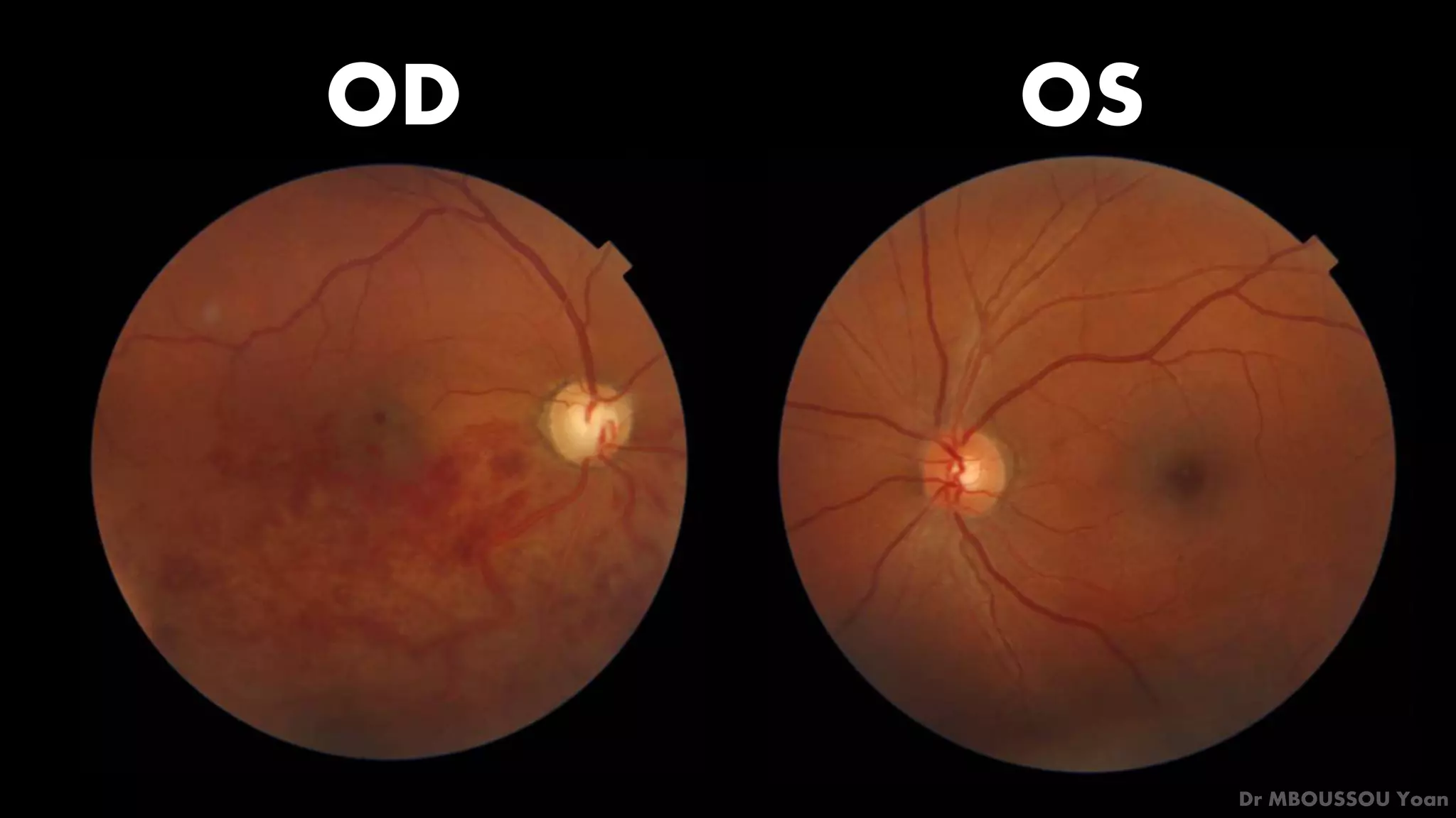 OCT of branch retinal vein occlusion. Clinical case | PPTX