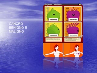 CANCRO BENIGNO E MALIGNO