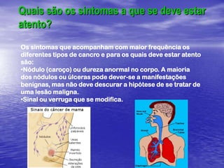 Quais são os sintomas a que se deve estar atento?Os sintomas que acompanham com maior frequência os diferentes tipos de cancro e para os quais deve estar atento são:Nódulo (caroço) ou dureza anormal no corpo. A maioria dos nódulos ou úlceras pode dever-se a manifestações benignas, mas não deve descurar a hipótese de se tratar de uma lesão maligna. 