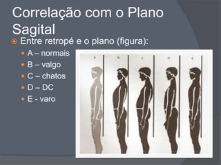 Correlação com o Plano
Sagital
   Entre retropé e o plano (figura):
     A – normais
     B – valgo
     C – chatos
     D – DC
     E - varo
 