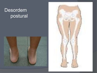 Desordem
  postural
 
