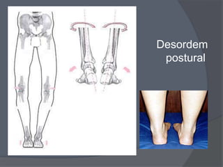 Desordem
 postural
 