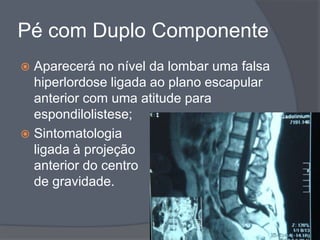 Pé com Duplo Componente
 Aparecerá no nível da lombar uma falsa
  hiperlordose ligada ao plano escapular
  anterior com uma atitude para
  espondilolistese;
 Sintomatologia
  ligada à projeção
  anterior do centro
  de gravidade.
 