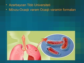 • Azərbaycan Tibb Universiteti
• Mövzu-Ocaqlı vərəm Ocaqlı vərəmin formaları
 