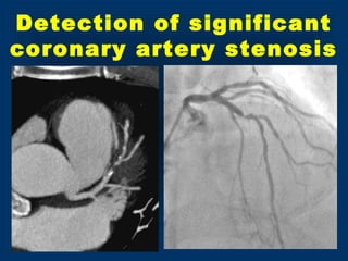 Detection of significant
coronary artery stenosis
 