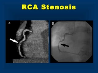 RCA StenosisRCA Stenosis
 