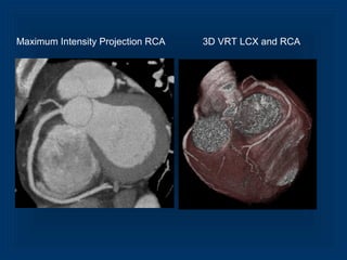 Maximum Intensity Projection RCA 3D VRT LCX and RCA
 