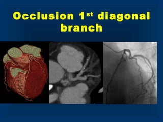 Occlusion 1st
diagonal
branch
 