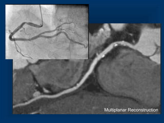 Multiplanar Reconstruction
 
