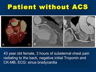 Patient without ACSPatient without ACS
43 year old female, 3 hours of substernal chest pain
radiating to the back, negative initial Troponin and
CK-MB, ECG: sinus bradycardia
 
