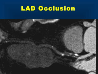 LAD Occlusion
 