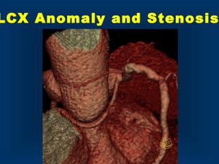 LCX Anomaly and Stenosis
 