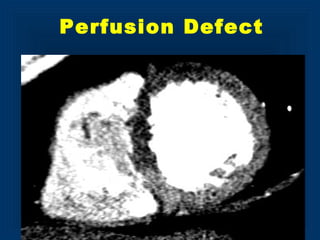 Perfusion Defect
 