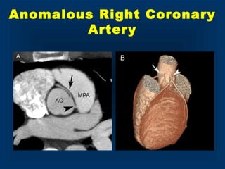 Anomalous Right Coronary
Artery
 