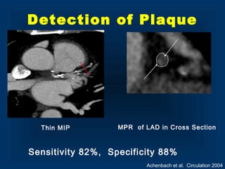 MPR of LAD in Cross SectionThin MIP
Detection of Plaque
Sensitivity 82%, Specificity 88%
Achenbach et al. Circulation 2004
 