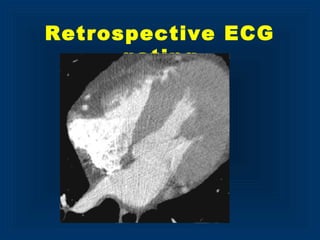 Retrospective ECG
gating
 