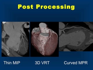 Thin MIP 3D VRT Curved MPR
Post Processing
 