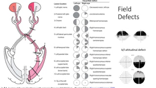 Field
Defects
b/l altitudinal defect
 
