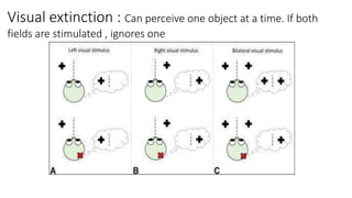 Visual extinction : Can perceive one object at a time. If both
fields are stimulated , ignores one
 